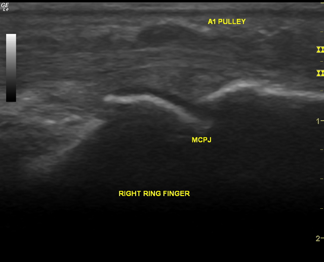 6 reasons why Ultrasound is useful in my Rheumatology hands