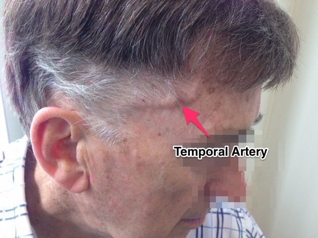 giant-cell-arteritis-a-rheumatological-emergency