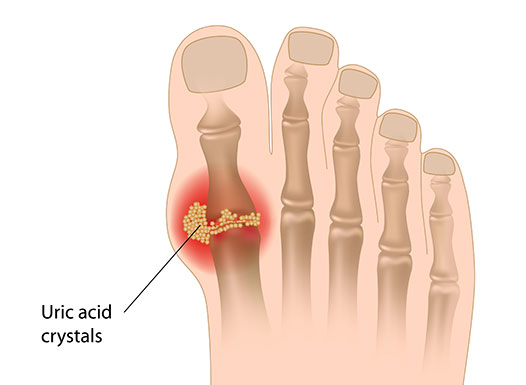 What Causes High Uric Acid Level | Gout | Gout Treatment