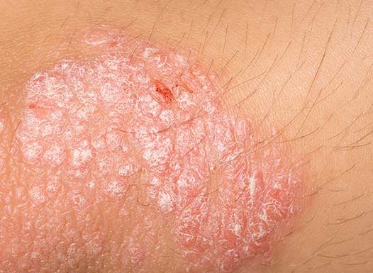 psoriasis