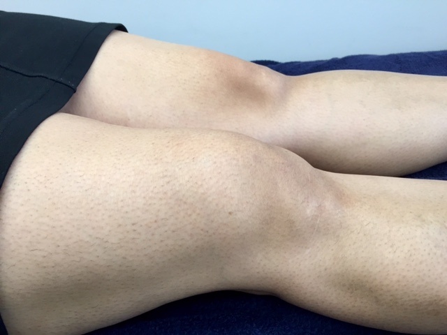 Knee Effusion 1.jpg