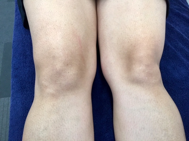 swelling and excess fluid in knee