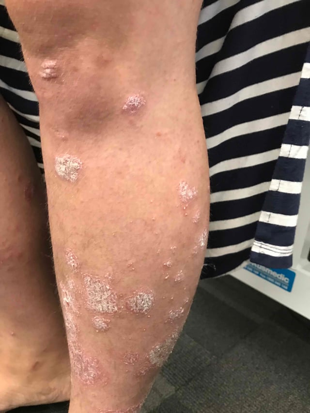 How aggressively should psoriasis in a teenager be treated?