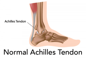 Tendinitis, Tendinopathy, Enthesitis: What’s what in the world of Tendons!